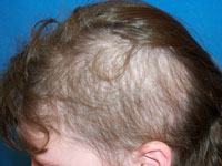 Child Hair Loss - Trichotillomania