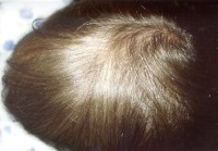 Child Hair Loss - Loose Anagen Syndrome