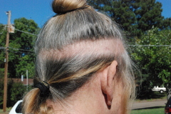 Excess radiation leaves a ring of baldness on Becky Coudert's scalp