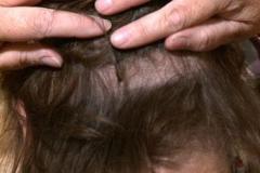 CT Scan leads to woman's hair loss