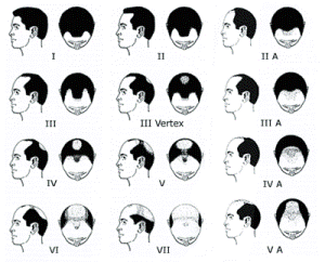 The Norwood Scale shows how Male Pattern Hair Loss progresses.