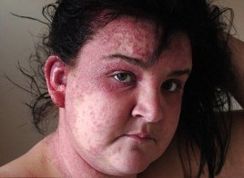 Woman's Hair Dye Disaster Burns, Swells and Blisters