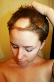 The Auto-Immune Disorder, Alopecia Areata, Leads to Sudden Bald Patches.