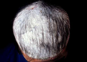 White Sticky Substance on Scalp Causing Hair Loss - Can You Help?