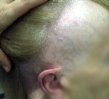 Frontal Fibrosing Alopecia