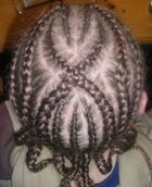 Dont Judge My Hair: Braiding Can Lead to Traction Alopecia