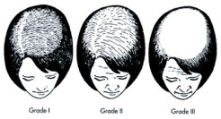 Androgenetic alopecia in women