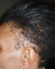 Traction alopecia pulls the hair out from the root