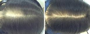 Click Here - Asian Hair Loss Success Story
