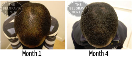 male pattern hair loss black afro carribean