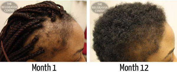 traction alopecia black afro caribbean