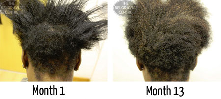 traction alopecia follicular degeneration syndrome black afro carribean