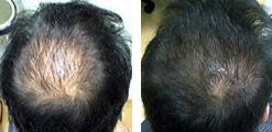 Medically approved and scientifically proven treatments for hair loss are helping people all over the world
