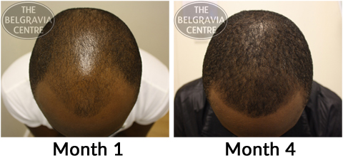 Hair Loss Treatment for Afro Hair