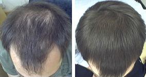 Hair Loss Treatment Comparison - "My hair is unrecognisably thicker”