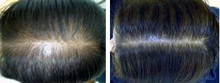 You can get your pre-baby hair back with effective treatments for female hair loss