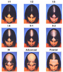 Stages of Female Hair Loss