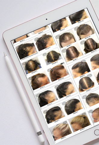 Female Pattern Hair Loss Treatment Success Stories The Belgravia Centre Hair Clinic Womens Thinning Hair