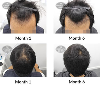 alert male pattern hair loss the belgravia centre 384555 21 01 2019