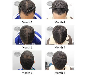 alert male pattern hair loss and traction alopecia the belgravia centre 387414 24 01 2020