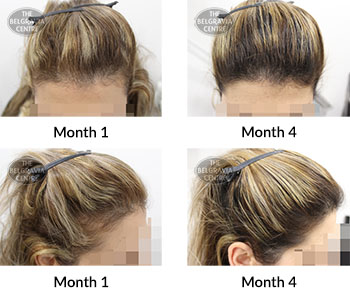 alert female pattern hair loss the belgravia centre 390591 29 01 2020