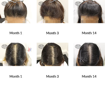 alert female pattern hair loss the belgravia centre 375120 31 01 2020