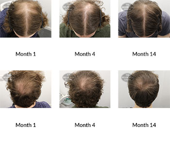 alert male pattern hair loss the belgravia centre 375160 06 02 2020
