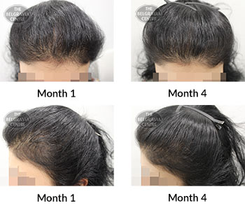 alert female pattern hair loss the belgravia centre 168980 07 02 2020