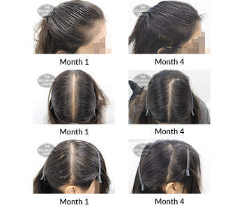 alert female pattern hair loss and diffuse thinning the belgravia centre 390984 11 02 2020