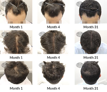 alert male pattern hair loss the belgravia centre 330701 14 02 2020