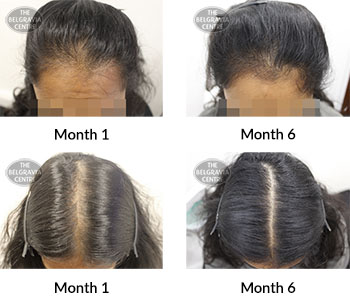 alert female pattern hair loss the belgravia centre 387143 17 02 2020