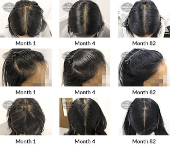 alert female pattern hair loss the belgravia centre 187581 25 02 2020