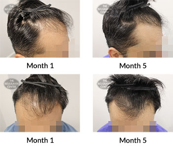 alert male pattern hair loss the belgravia centre 388763 25 02 2020