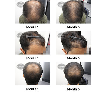 alert male pattern hair loss the belgravia centre 389823 02 03 2020