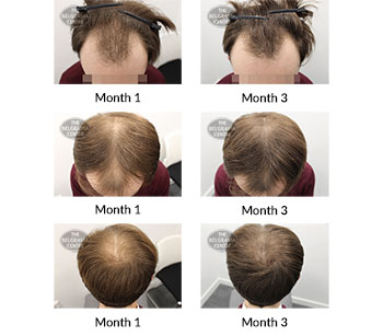 alert male pattern hair loss the belgravia centre 393004 03 03 2020