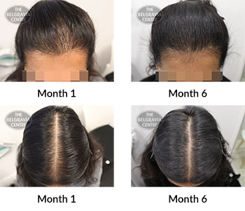 alert female pattern hair loss the belgravia centre 389944 09 03 2020