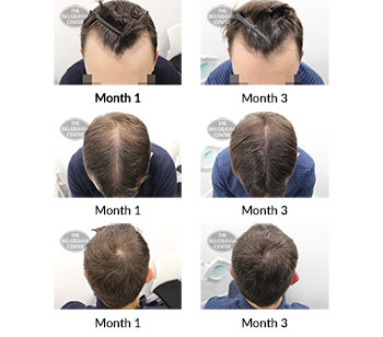alert male pattern hair loss the belgravia centre 393303 11 03 2020