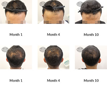 alert male pattern hair loss the belgravia centre 382600 13 03 2020