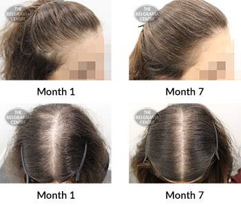alert female pattern hair loss and diffuse thinning the belgravia centre 385998 22 03 2020