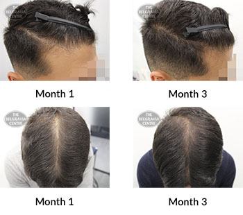 alert male pattern hair loss the belgravia centre 394003 27 03 2020