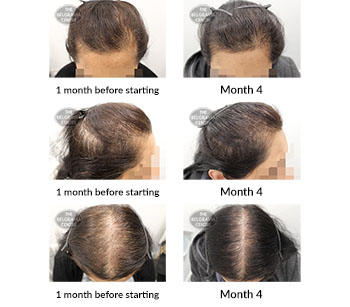 alert female pattern hair loss and diffuse hair loss the belgravia centre 184565 27 03 2020
