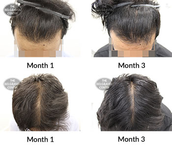 alert male pattern hair loss the belgravia centre 392776 19 02 2020