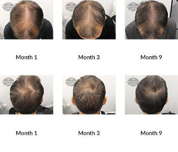 alert male pattern hair loss the belgravia centre 385363 08 04 2020