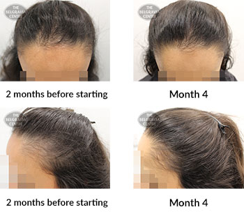 alert female pattern hair loss the belgravia centre 388445 09 04 2020