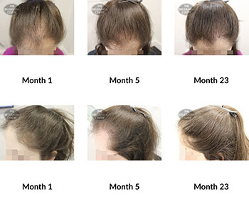 alert female pattern hair loss the belgravia centre 359339 10 04 2020