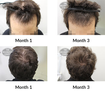 alert male pattern hair loss the belgravia centre 392680 14 04 2020