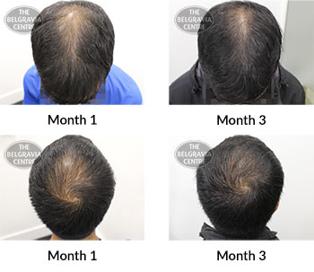 alert male pattern hair loss the belgravia centre 391667 20 02 2020