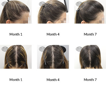 alert female pattern hair loss and diffuse thinning the belgravia centre 388957 21 04 2020