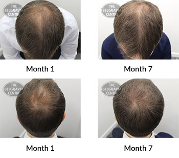 alert male pattern hair loss the belgravia centre 387123 22 04 2020
