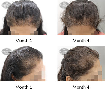 alert female pattern hair loss the belgravia centre 389057 23 04 2020